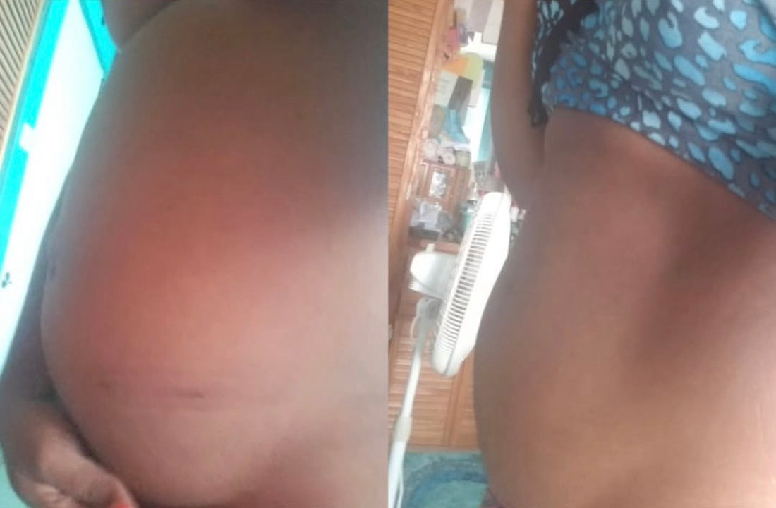 Maria's Fibroid Shrinkage Journey